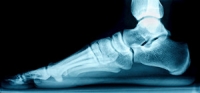 Various Reasons to Have Flat Feet