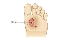 Recognizing and Treating Diabetic Foot Ulcers Early