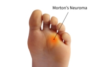 Causes and Diagnosis of Morton’s Neuroma